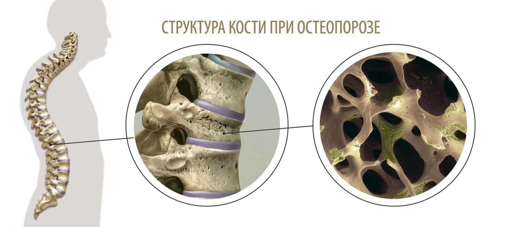 Классификация остеопороз