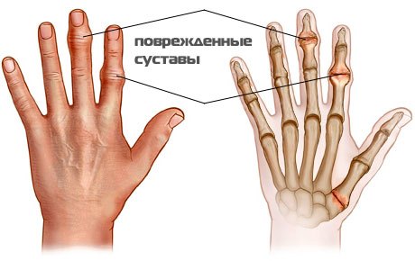 Схема поражения артритом пальцев