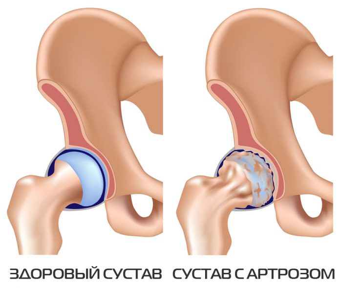 Артроз