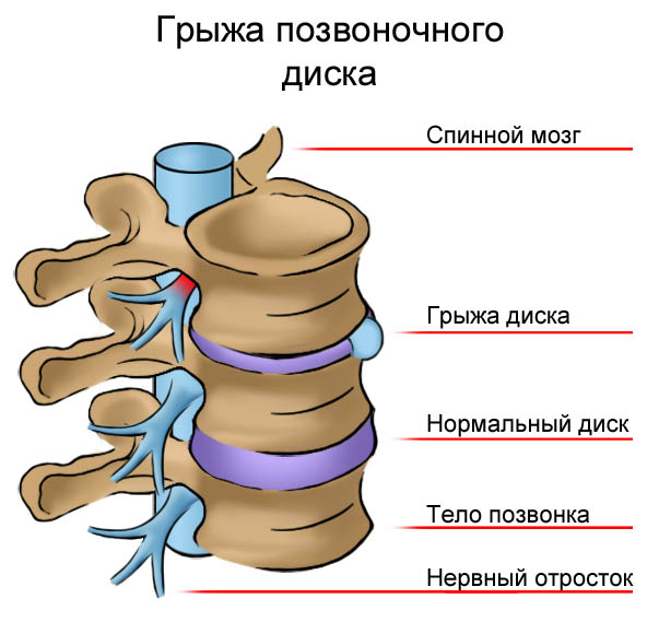 Межпозвоночная грыжа