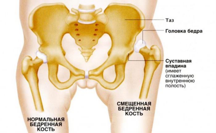 Дисплазия суставов
