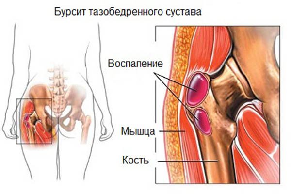 Воспаление суставной сумки