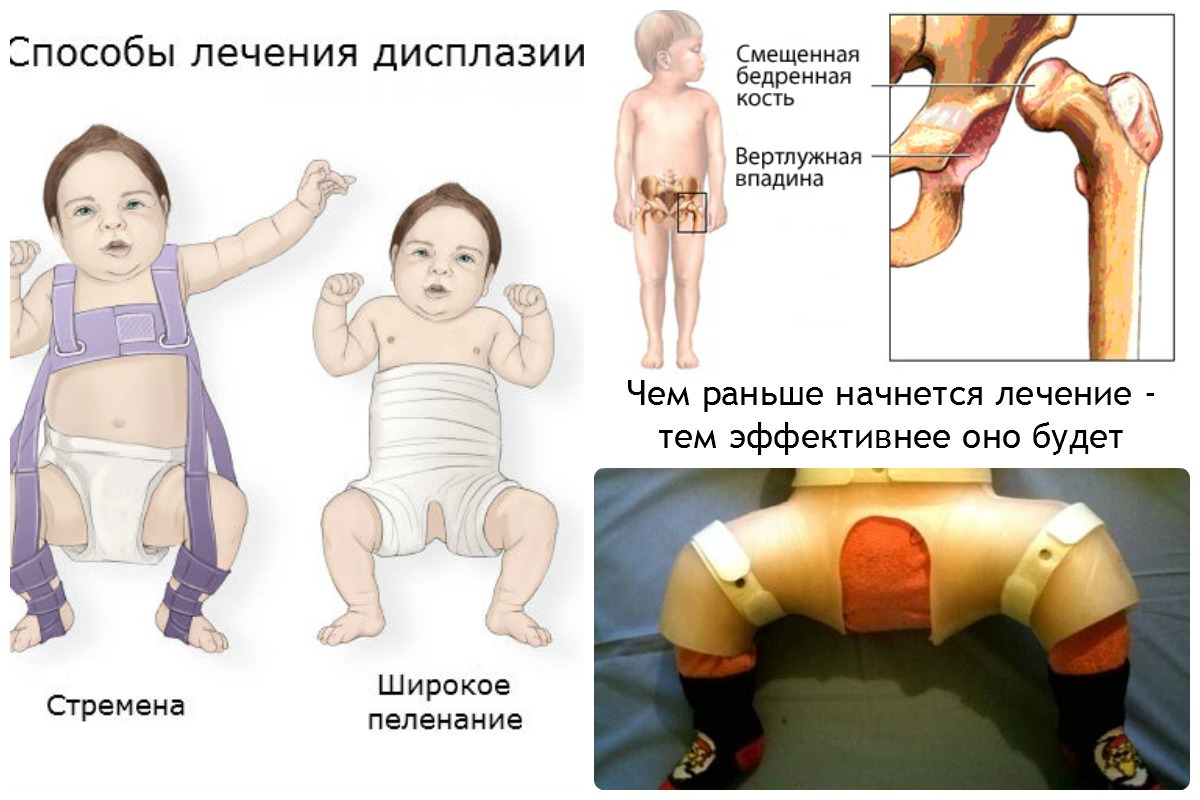Способы лечения дисплазии