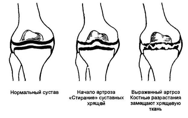 Стадии деформирующего артроза