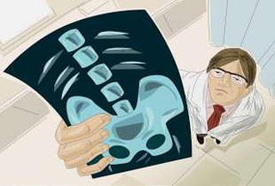 деформирующий остеоартроз