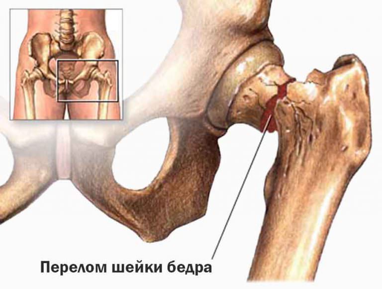Повреждение бедренной шейки
