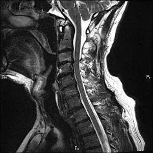 Диагностика грыжи в шейном отделе позвоночника