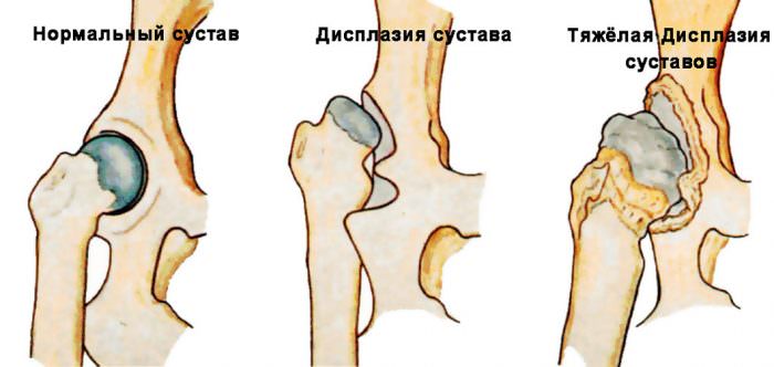 Неоартроз