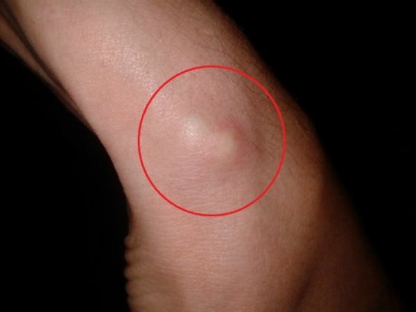 гигрома запястья