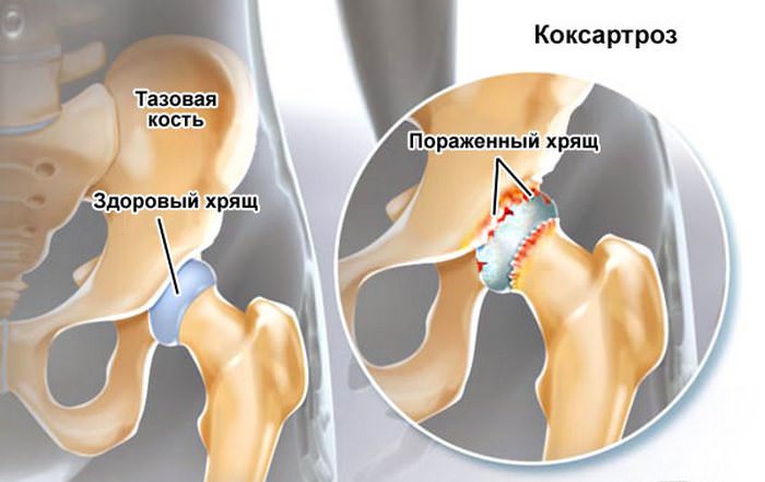 Здоровый и больно хрящ