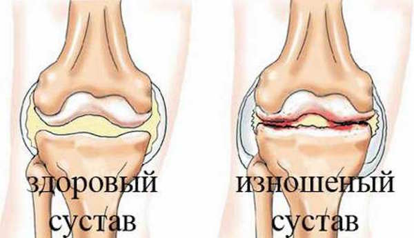 Хрустят суставы