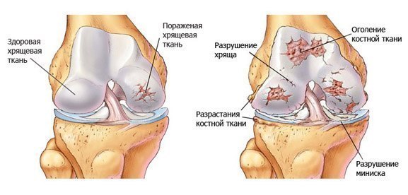 Хрустят суставы