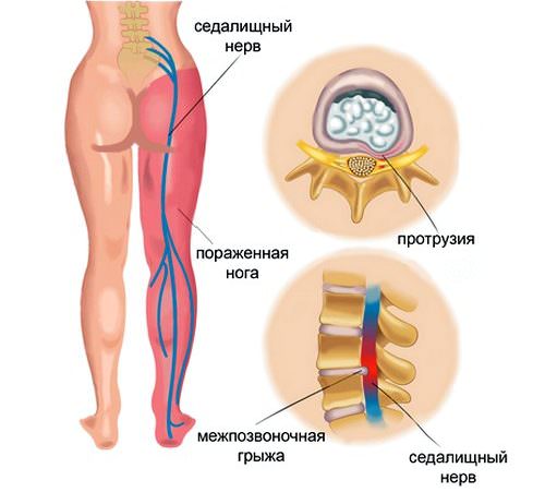 Зона воспаления