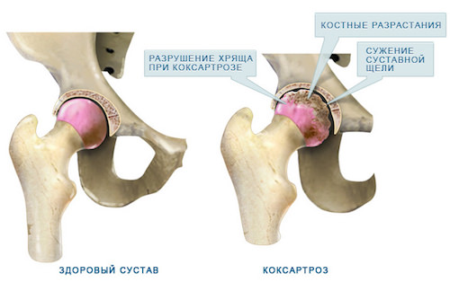 Коксартроз