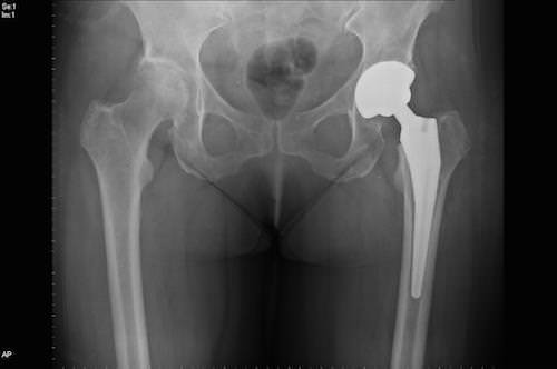 Коксартроз