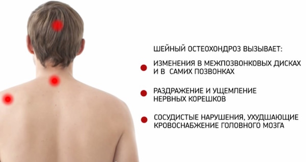 Лфк при остеохондрозе шейного отдела