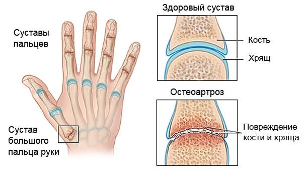 Проявления остеоартроза