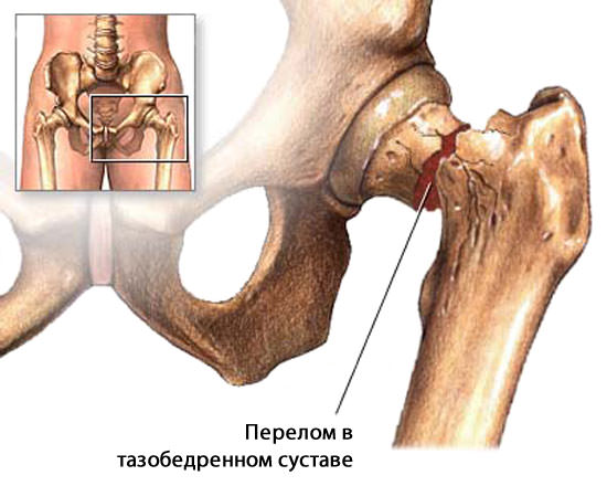 Повреждение шейки бедра