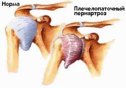 Плечелопаточный периартроз