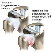 Плечелопаточный периартроз