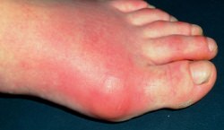 Подагрический артрит: лечение