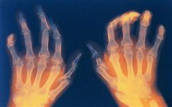 Полиартрит пальцев рук