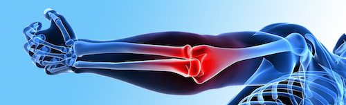 ревматизм суставов