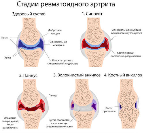 ревматоидный артрит