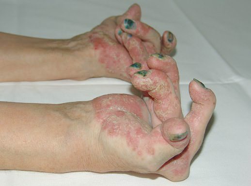 revmatoidnyj artrit 3