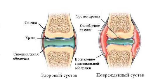 ревматоидный артрит