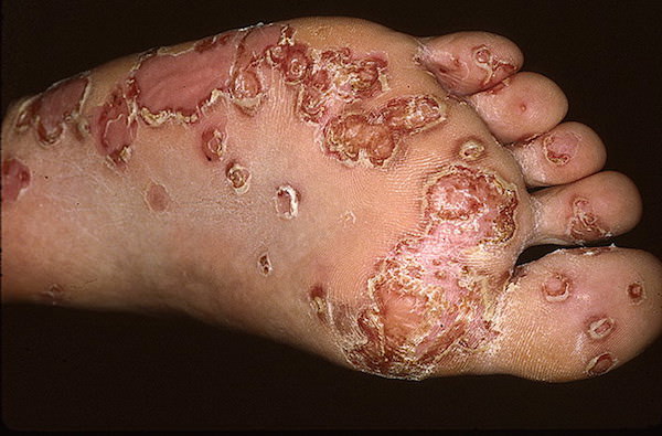 Синдром Рейтена