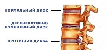 спондилоартроз грудного отдела позвоночника