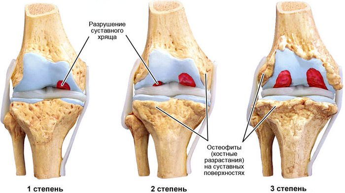 Степени артроза коленного сустава