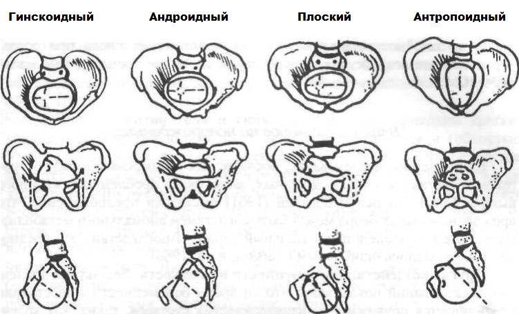 Формы таза