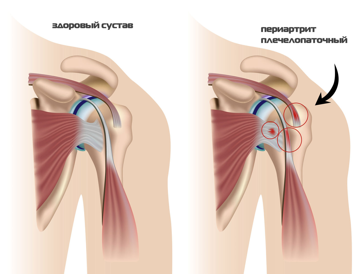 Вид нормального и больного сустава