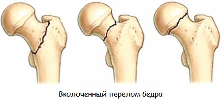 Вколоченный перелом шейки бедра