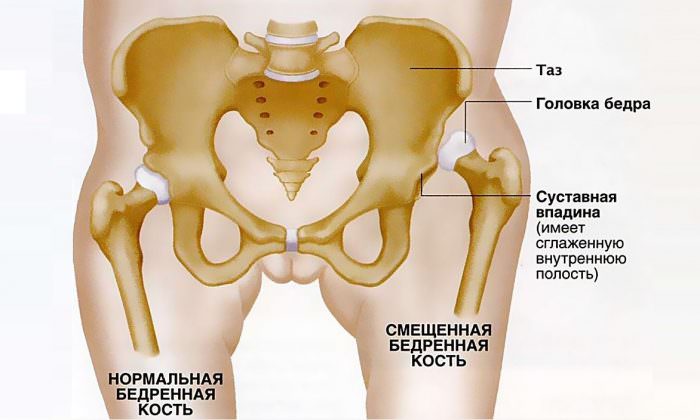 Вывихи у взрослых