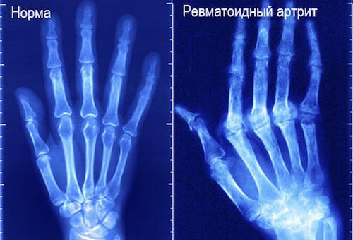 ювенильный ревматоидный артрит