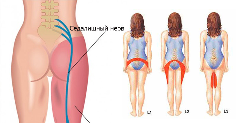 Защемление нерва
