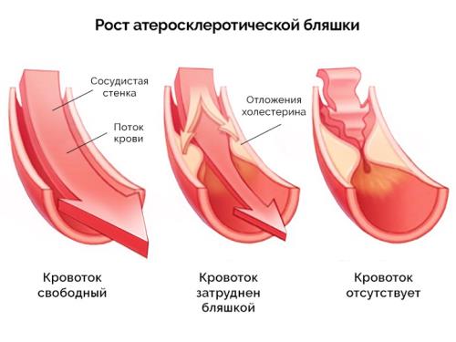 Атеросклероз