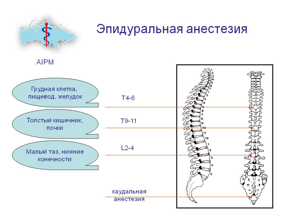 Эпидуральная анестезия