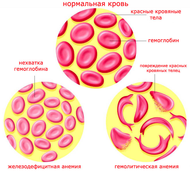Гемолитическая анемия