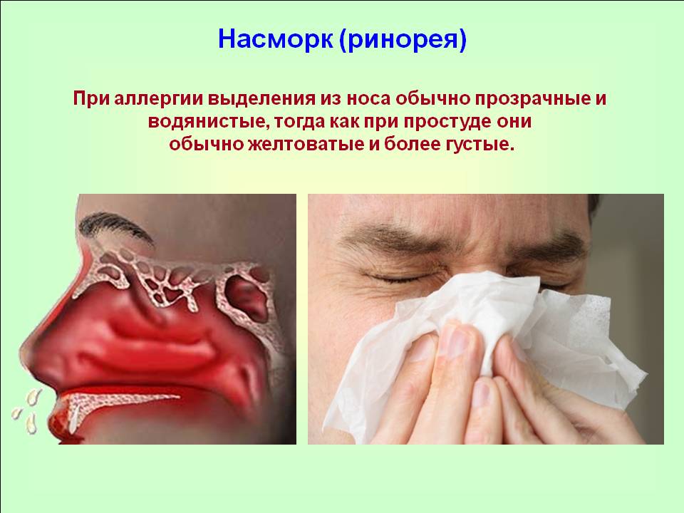 Ринорея