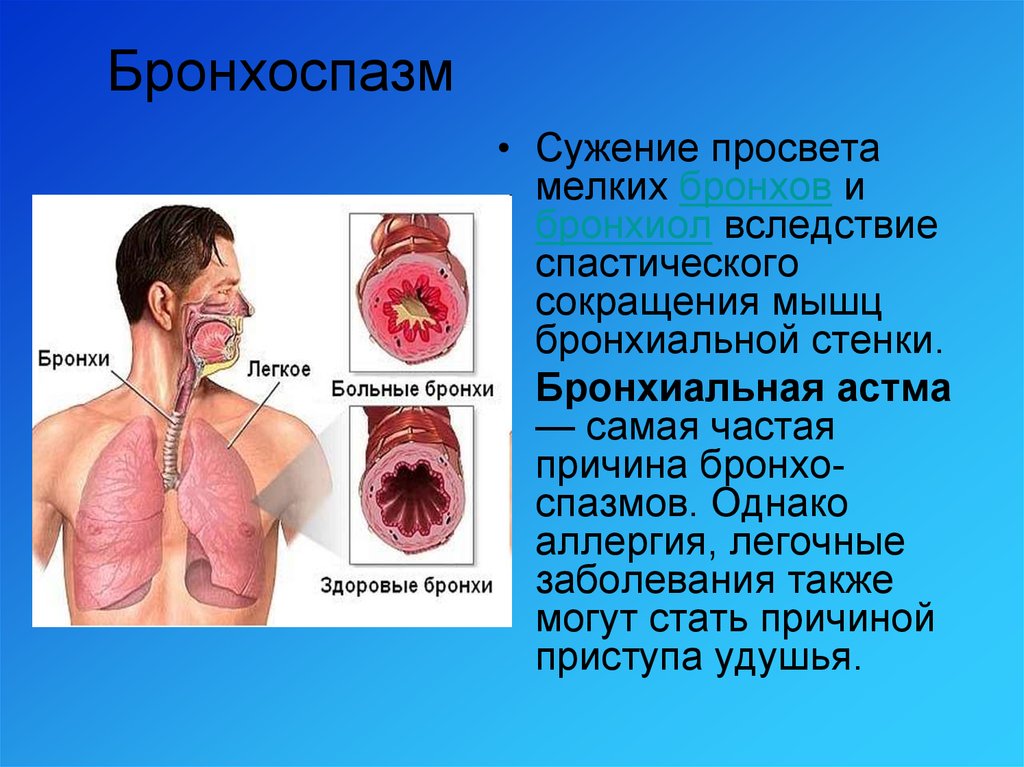 Бронхоспазм