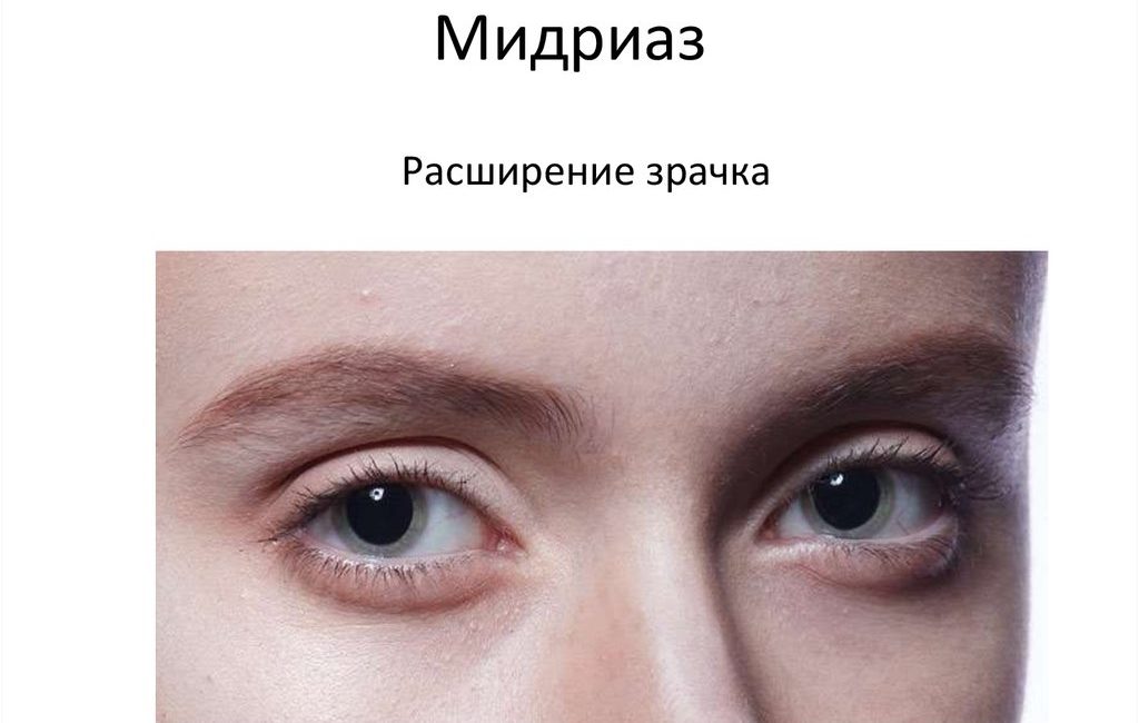 Мидриаз
