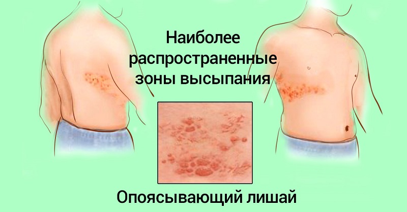 Опоясывающий лишай 