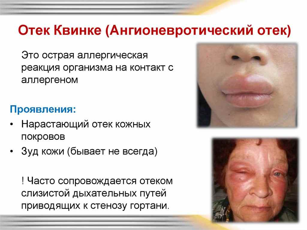 Ангионевротический отек