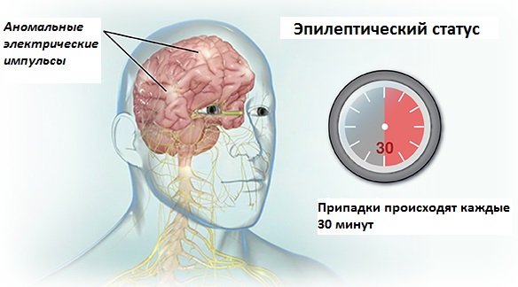 Эпилептический статус