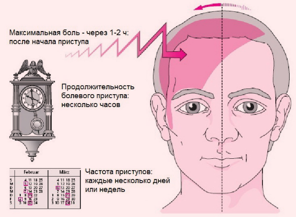 Мигрень