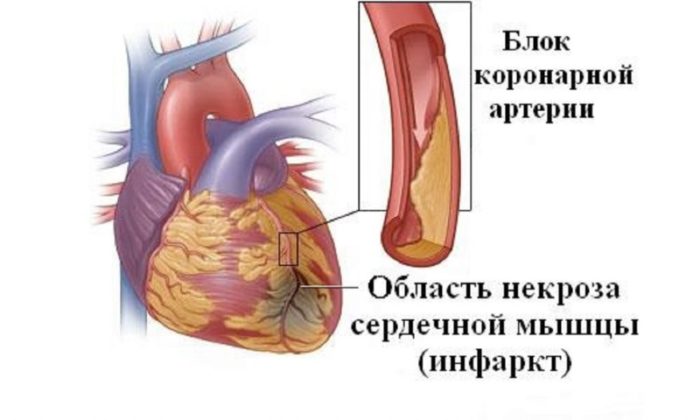 Инфаркт